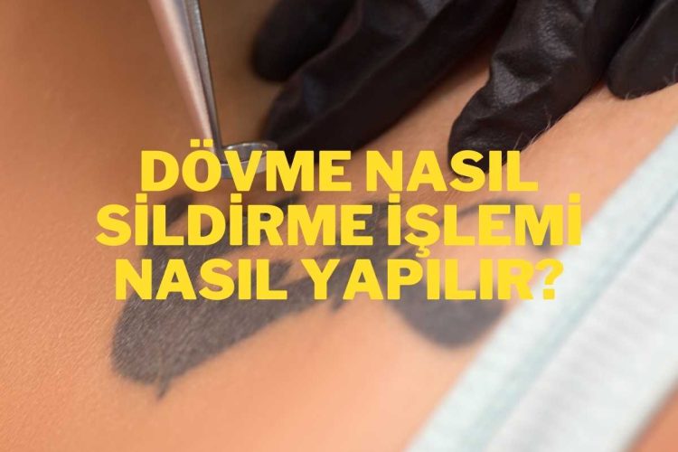 Dövme Sildirme İşlemi Nasıl Yapılır?