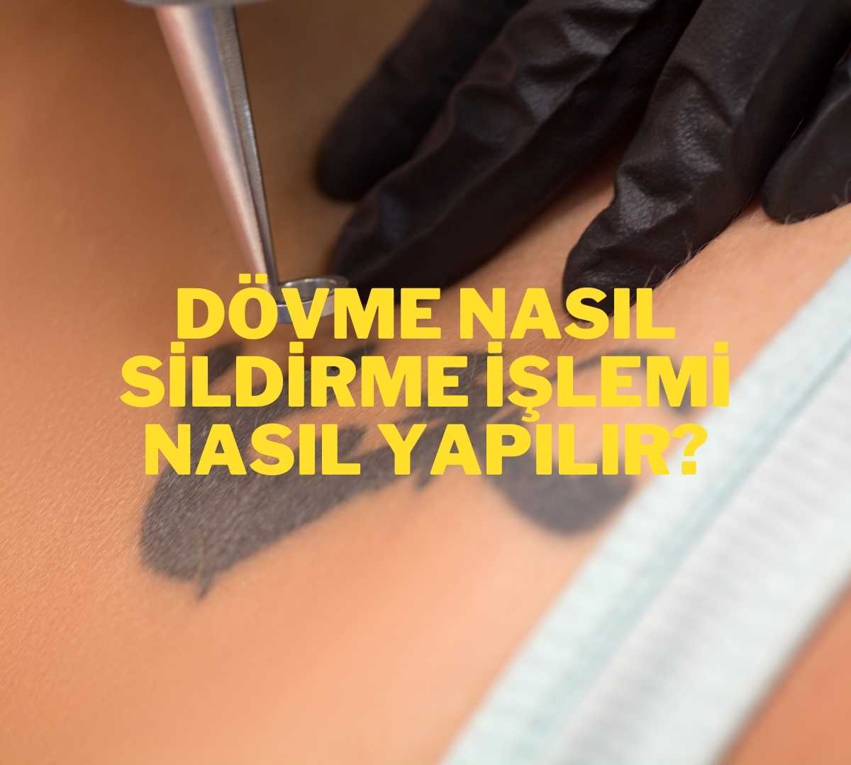 Dövme Sildirme İşlemi Nasıl Yapılır?