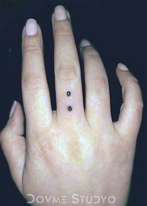 Parmak Dermal Piercing